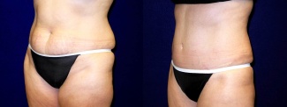 Left 3/4 View - Tummy Tuck After Pregnancy