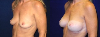 Left 3/4 View - Breast Augmentation - Silicone Implants