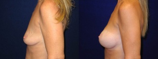 Left Profile View - Breast Augmentation - Silicone Implants