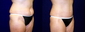 Right 3/4 View - Tummy Tuck After Pregnancy