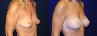 Right 3/4 View - Breast Augmentation - Silicone Implants