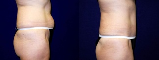 Right Profile View - Tummy Tuck After Pregnancy