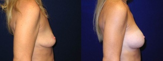 Right Profile View - Breast Augmentation - Silicone Implants