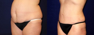 Left 3/4 View - Tummy Tuck After Pregnancy