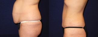 Left Profile View - Tummy Tuck After Pregnancy