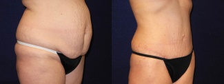 Right 3/4 View - Tummy Tuck After Pregnancy