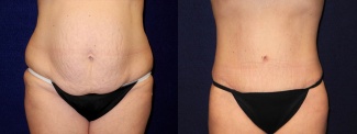 Frontal View - Tummy Tuck After Pregnancy