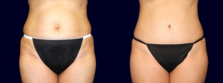 Frontal View - Tummy Tuck After Pregnancy