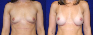 Frontal View - Breast Augmentation - Silicone Implants