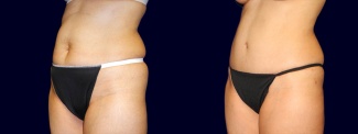 Left 3/4 View - Tummy Tuck After Pregnancy