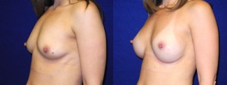 Left 3/4 View - Breast Augmentation - Silicone Implants