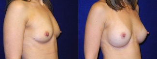 Right 3/4 View - Breast Augmentation - Silicone Implants