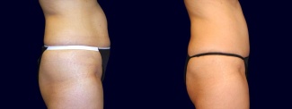 Right Profile View - Tummy Tuck After Pregnancy