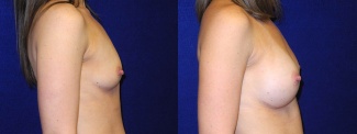 Right Profile View - Breast Augmentation with Silicone Implants