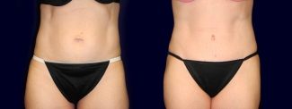 Frontal View - Tummy Tuck After Pregnancy