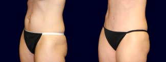 Left 3/4 View - Tummy Tuck After Pregnancy