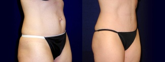 Right 3/4 View - Tummy Tuck After Pregnancy