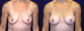 Frontal View - Breast Augmentation - Silicone Implants