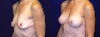 Left 3/4 View - Breast Augmentation - Silicone Implants