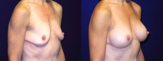 Right 3/4 View - Breast Augmentation - Silicone Implants