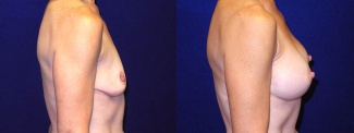 Right Profile View - Breast Augmentation - Silicone Implants