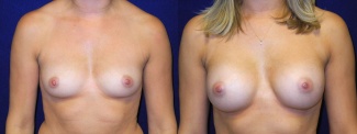 Frontal View - Breast Augmentation - Silicone Implants