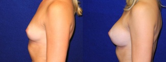 Left Profile View - Breast Augmentation - Silicone Implants