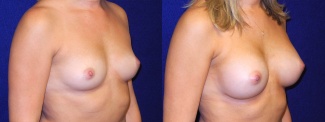 Right 3/4 View - Breast Augmentation - Silicone Implants