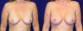 Frontal View - Breast Augmentation - Silicone Implants