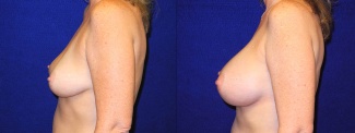 Left Profile View - Breast Augmentation - Silicone Implants