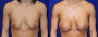 Frontal View - Breast Augmentation - Silicone Implants