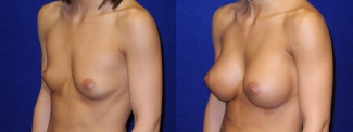 Left 3/4 View - Breast Augmentation - Silicone Implants