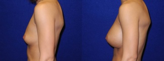 Left Profile View - Breast Augmentation - Silicone Implants