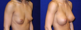 Right 3/4 View - Breast Augmentation - Silicone Implants