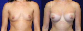 Frontal View - Breast Augmentation - Silicone Implants
