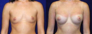 Frontal View - Breast Augmentation - Silicone Implants