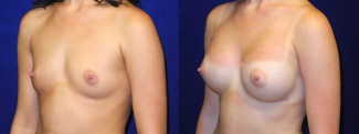 Left 3/4 View - Breast Augmentation - Silicone Implants