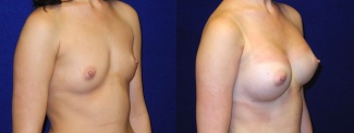 Right 3/4 View - Breast Augmentation - Silicone Implants