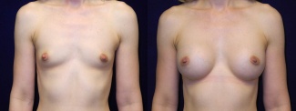 Frontal View - Breast Augmentation - Silicone Implants