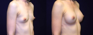 Left 3/4 View - Breast Augmentation - Silicone Implants