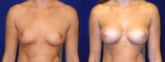 Frontal View - Breast Augmentation - Silicone Implants