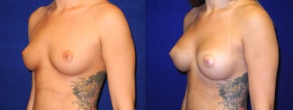 Left 3/4 View - Breast Augmentation - Silicone Implants