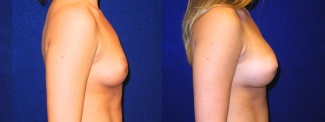 Right Profile View - Breast Augmentation - Silicone Implants