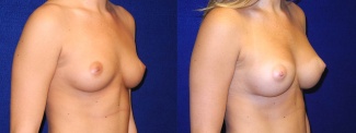 Right 3/4 View - Breast Augmentation - Silicone Implants