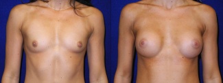 Frontal View - Breast Augmentation - Silicone Implants