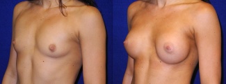 Left 3/4 View - Breast Augmentation - Silicone Implants