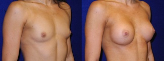 Right 3/4 View - Breast Augmentation - Silicone Implants