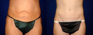 Frontal View - Circumferential Tummy Tuck 