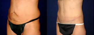 Left 3/4 View - Circumferential Tummy Tuck 