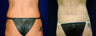 Posterior View - Circumferential Tummy Tuck 